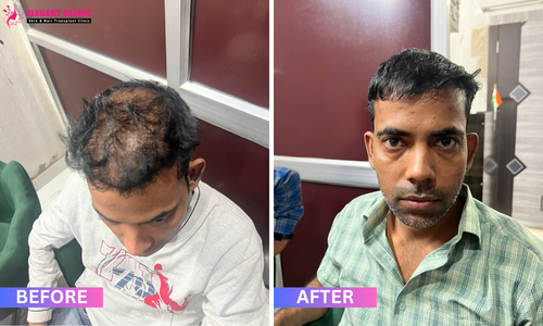 best hair transplant result in patna